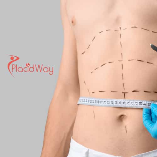 Abdominoplasty (Tummy Tuck) in Turkey for Stuttgart Patients Following Weight Loss